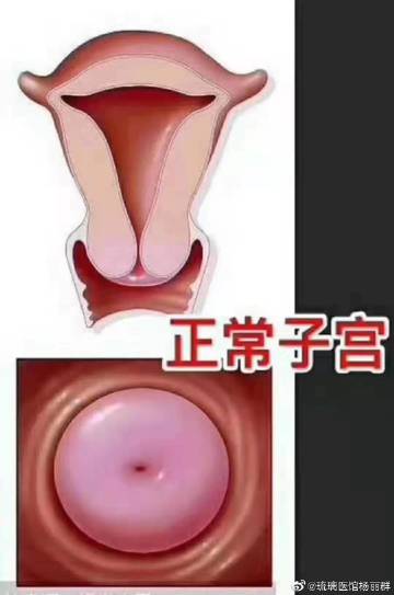 宫颈 糜烂: 1一度宫 颈 糜烂的症状:... 来自琉璃医馆杨丽群